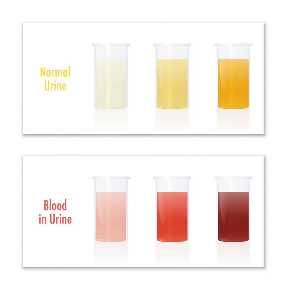 Blood in urine and normal urine in specimen cups, as comparison for laboratory examination and medical diagnosis of various urological diseases