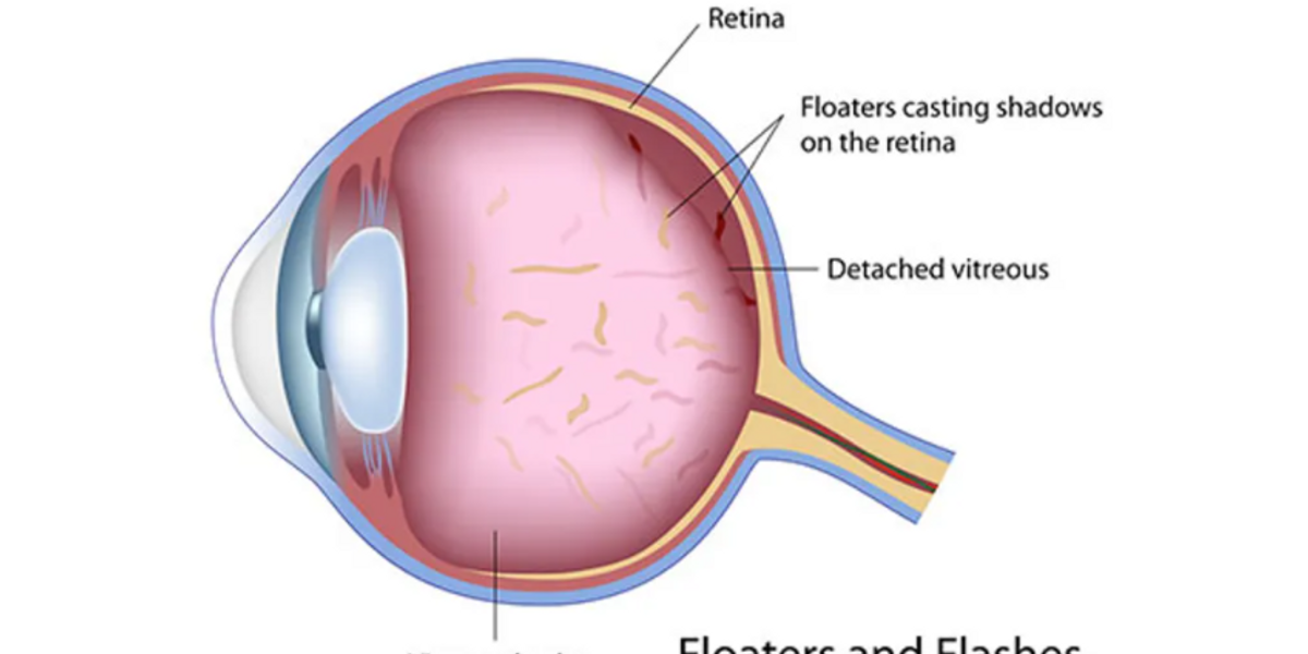 do-you-know-the-symptoms-of-retinal-detachment-healthywomen