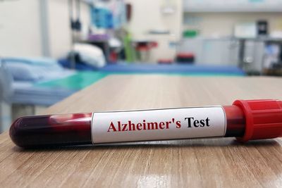 Laboratory sample of blood testing for diagnosis Alzheimer's disease