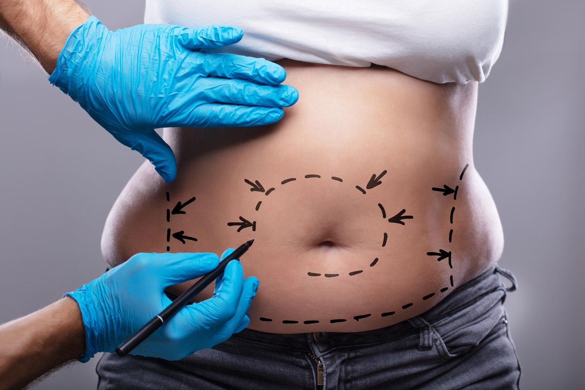 Am I Candidate for a Tummy Tuck?