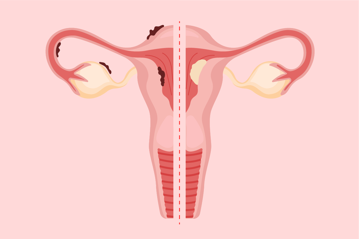 Is It Endometriosis or Endometrial Cancer? - HealthyWomen